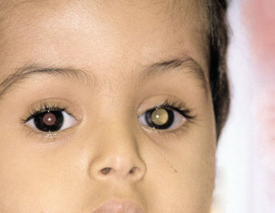 RETINOBLASTOMA